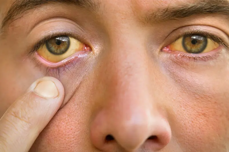 Jaundice (Yakrit Pitta)